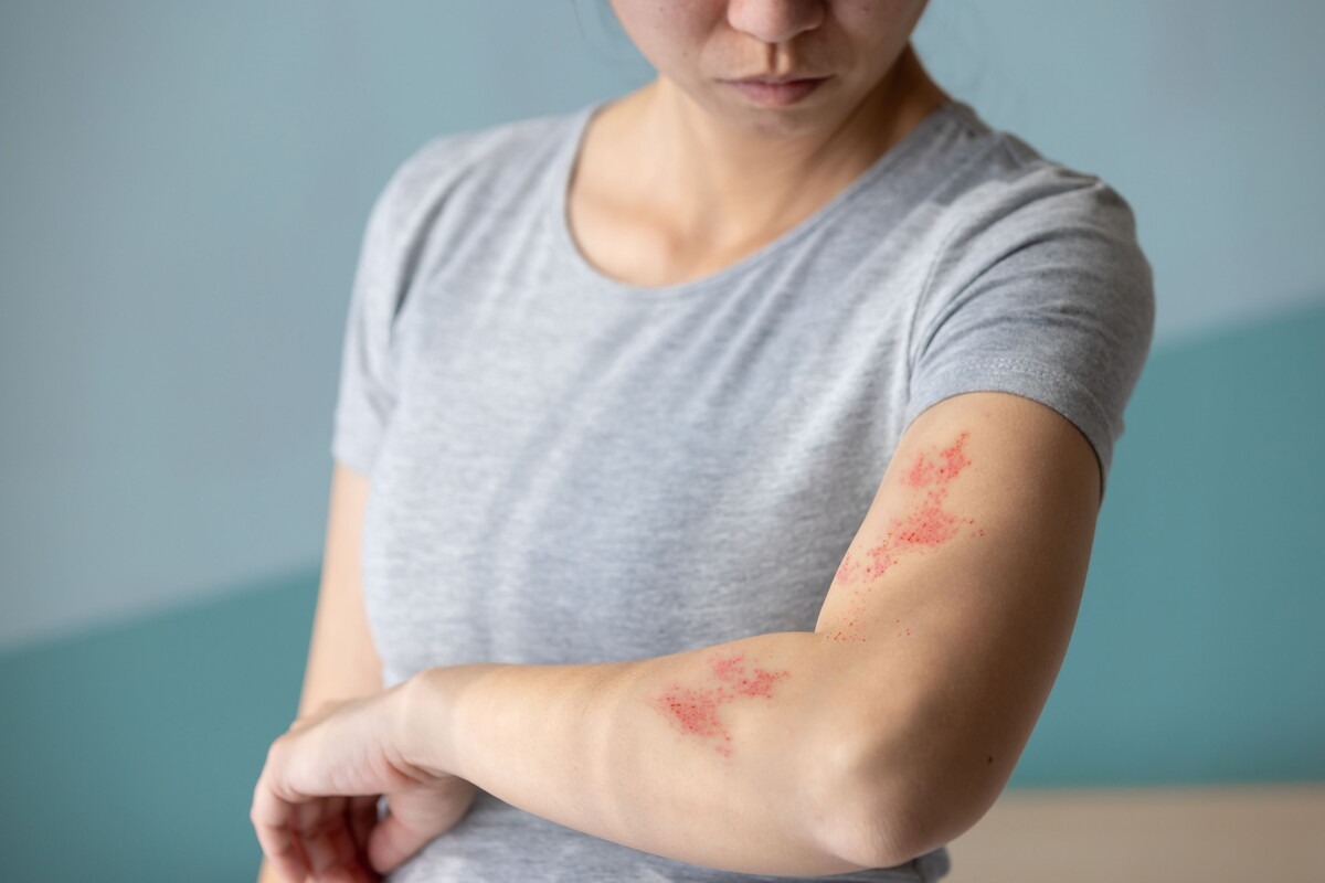 Vrouw met uitslag op haar arm